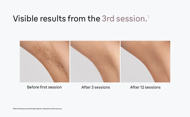 Three images of the underarm comparing hair growth before using Braun Silk·expert Mini and after 3 and 12 sessions.